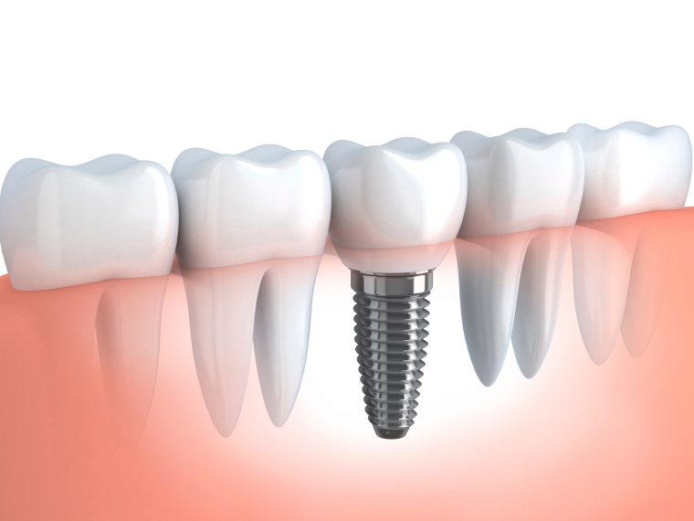 Dental Implants Santa Clara | Implant Dentist Santa Clara Califo